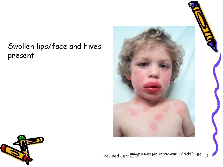 Swollen lips/face and hives present www. sovereign-publications. com/. . . /ANAPHYL. jpg Revised July