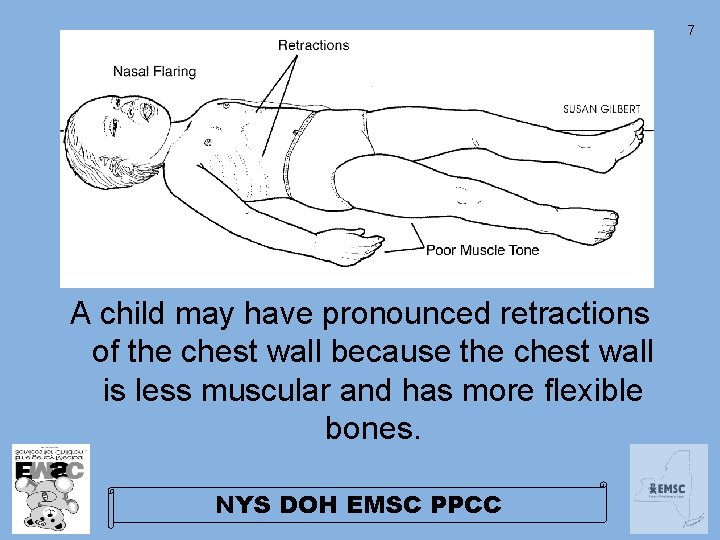 7 A child may have pronounced retractions of the chest wall because the chest 7 A child may have pronounced retractions of the chest wall because the chest