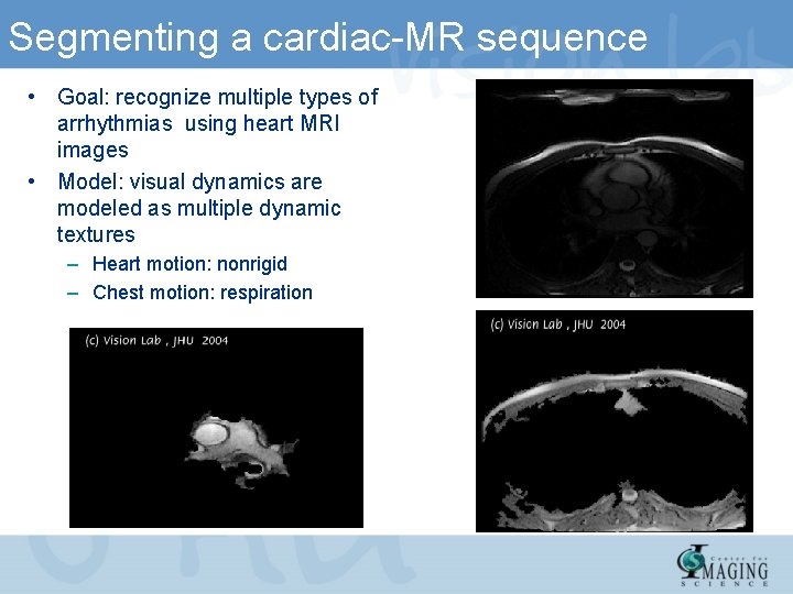Segmenting a cardiac-MR sequence • Goal: recognize multiple types of arrhythmias using heart MRI