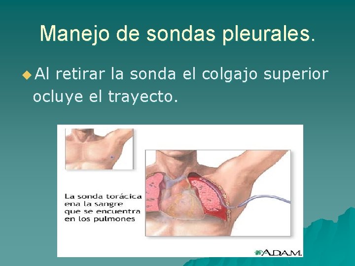 Manejo de sondas pleurales. u Al retirar la sonda el colgajo superior ocluye el