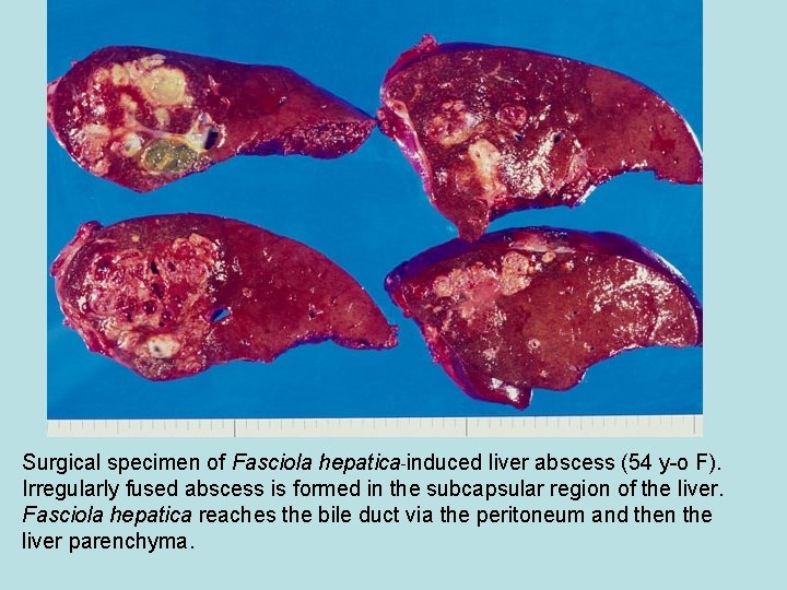 Surgical specimen of Fasciola hepatica-induced liver abscess (54 y-o F). Irregularly fused abscess is