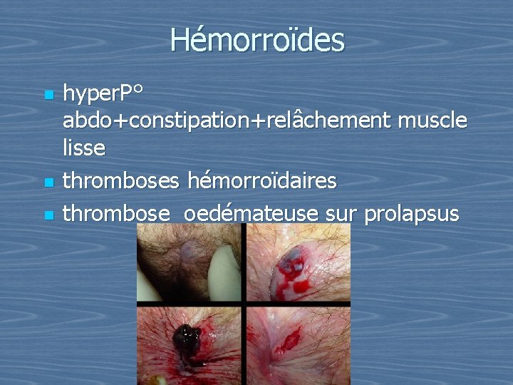 Hémorroïdes n n n hyper. P° abdo+constipation+relâchement muscle lisse thromboses hémorroïdaires thrombose oedémateuse sur