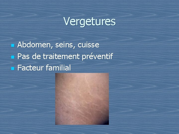 Vergetures n n n Abdomen, seins, cuisse Pas de traitement préventif Facteur familial 