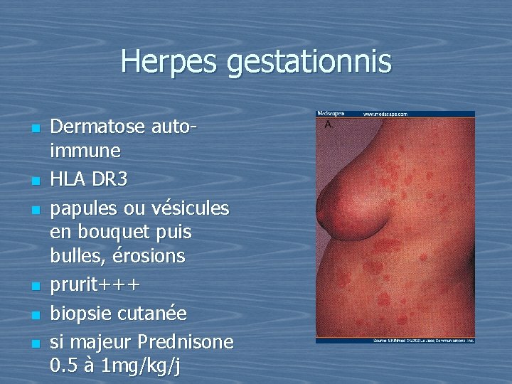 Herpes gestationnis n n n Dermatose autoimmune HLA DR 3 papules ou vésicules en