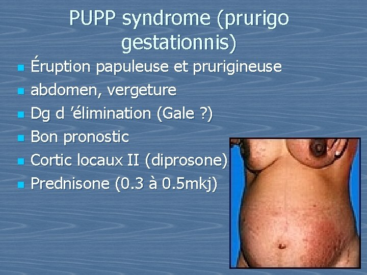 PUPP syndrome (prurigo gestationnis) n n n Éruption papuleuse et prurigineuse abdomen, vergeture Dg