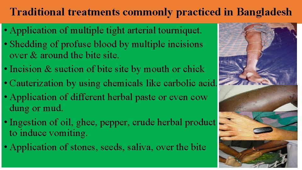 Traditional treatments commonly practiced in Bangladesh • Application of multiple tight arterial tourniquet. •