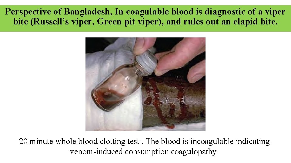 Perspective of Bangladesh, In coagulable blood is diagnostic of a viper bite (Russell’s viper,