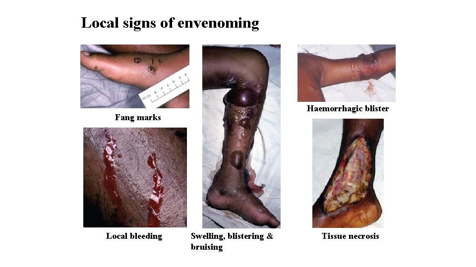 Local signs of envenoming Haemorrhagic blister Fang marks Local bleeding Swelling, blistering & bruising