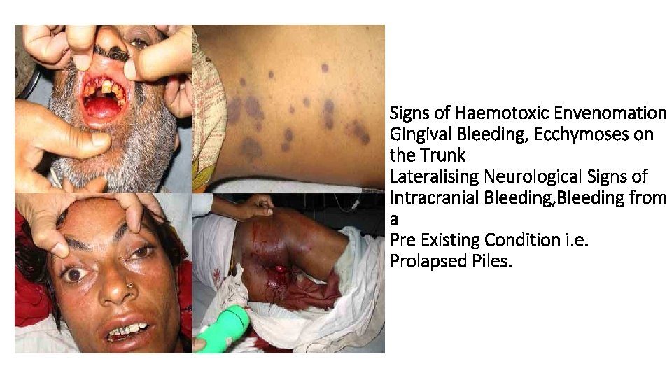 Signs of Haemotoxic Envenomation Gingival Bleeding, Ecchymoses on the Trunk Lateralising Neurological Signs of