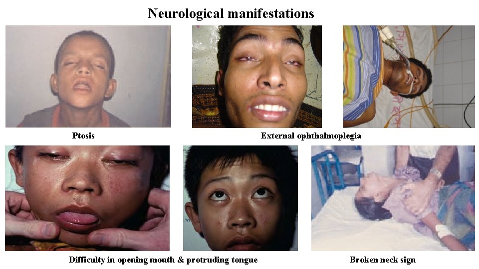 Neurological manifestations Ptosis Difficulty in opening mouth & protruding tongue External ophthalmoplegia Broken neck