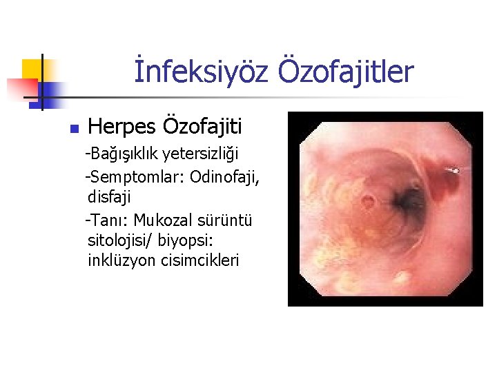İnfeksiyöz Özofajitler n Herpes Özofajiti -Bağışıklık yetersizliği -Semptomlar: Odinofaji, disfaji -Tanı: Mukozal sürüntü sitolojisi/