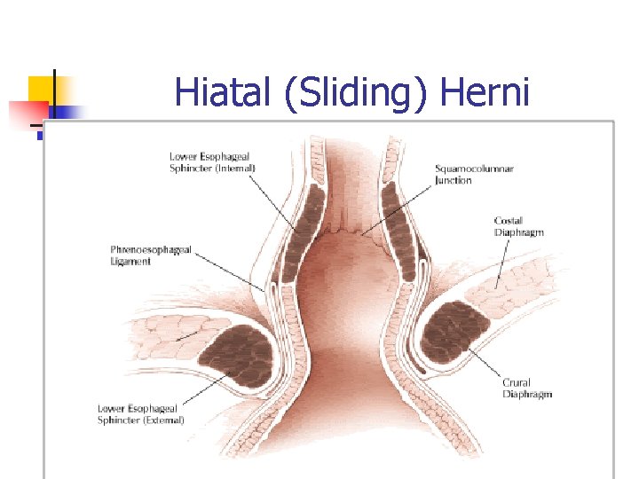 Hiatal (Sliding) Herni 