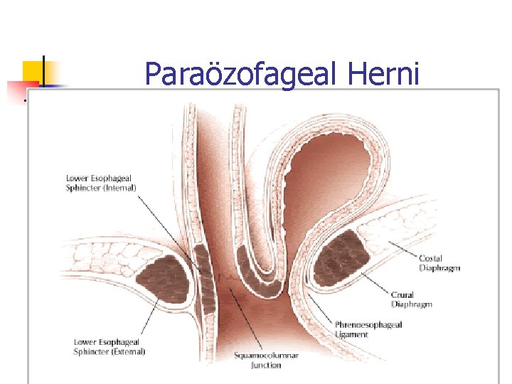 Paraözofageal Herni 