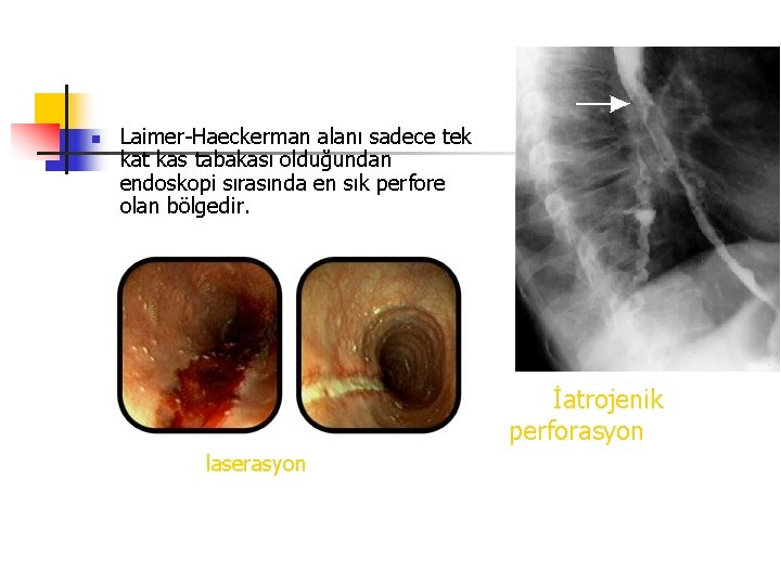 n Laimer-Haeckerman alanı sadece tek kat kas tabakası olduğundan endoskopi sırasında en sık perfore