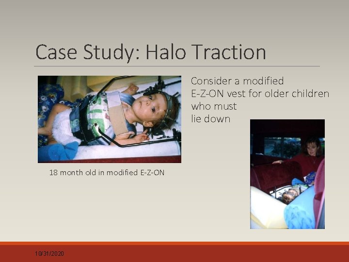 Case Study: Halo Traction Consider a modified E-Z-ON vest for older children who must