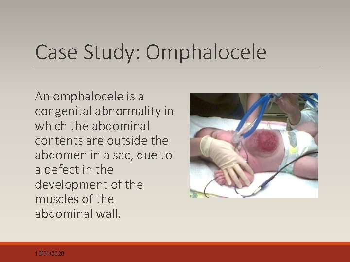 Case Study: Omphalocele An omphalocele is a congenital abnormality in which the abdominal contents