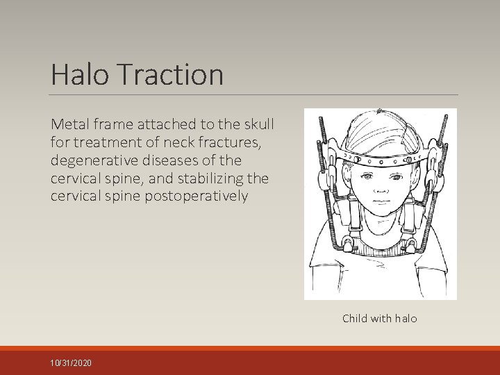 Halo Traction Metal frame attached to the skull for treatment of neck fractures, degenerative