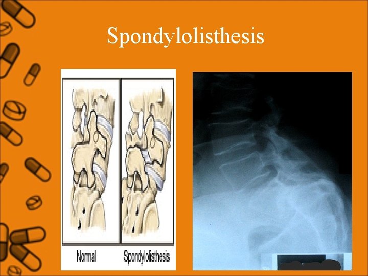 Spondylolisthesis 