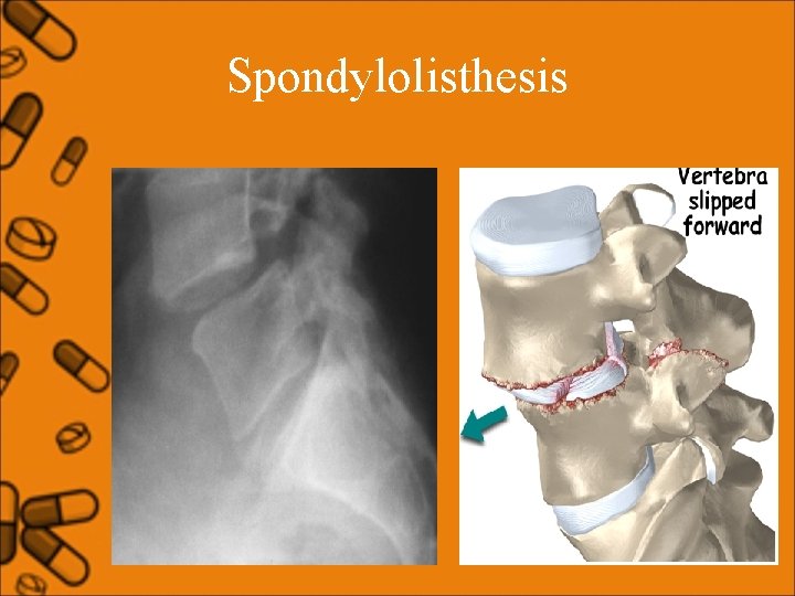 Spondylolisthesis 