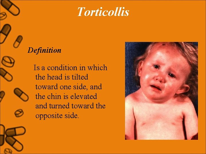Torticollis Definition Is a condition in which the head is tilted toward one side,