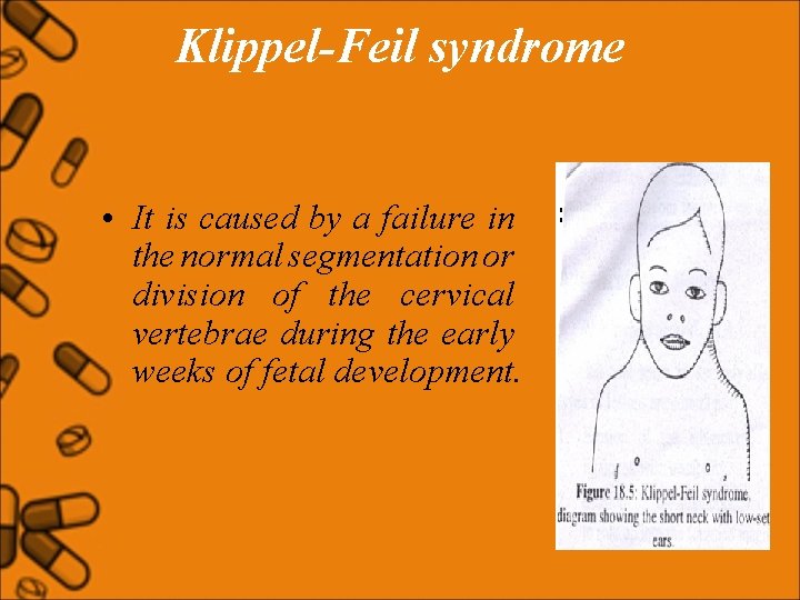 Klippel-Feil syndrome • It is caused by a failure in the normal segmentation or