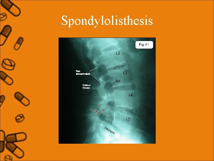 Spondylolisthesis 