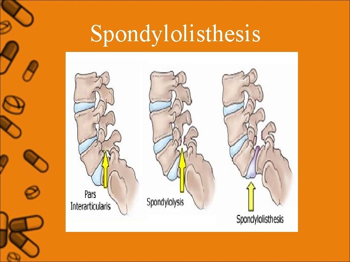 Spondylolisthesis 