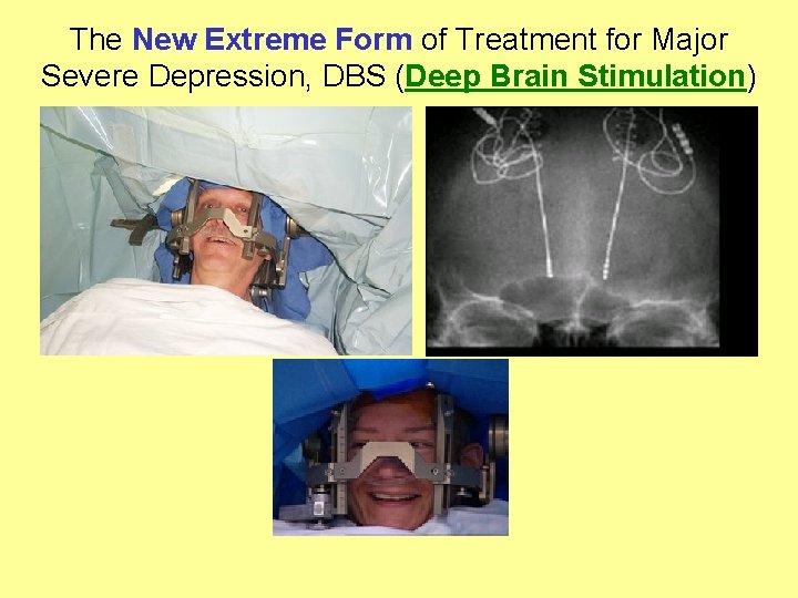 The New Extreme Form of Treatment for Major Severe Depression, DBS (Deep Brain Stimulation)