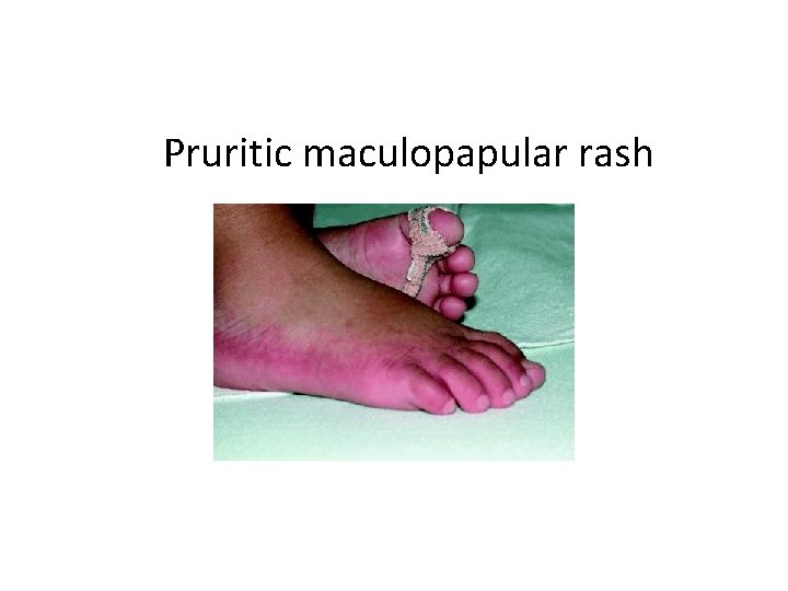Pruritic maculopapular rash 
