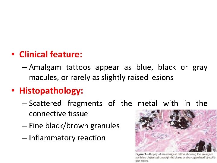  • Clinical feature: – Amalgam tattoos appear as blue, black or gray macules,