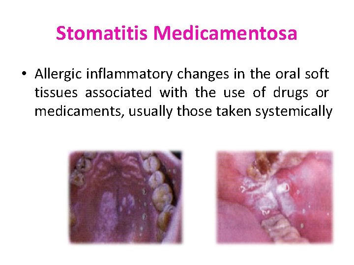 Stomatitis Medicamentosa • Allergic inflammatory changes in the oral soft tissues associated with the