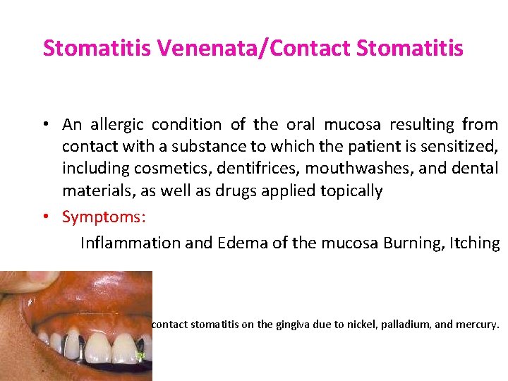 Stomatitis Venenata/Contact Stomatitis • An allergic condition of the oral mucosa resulting from contact
