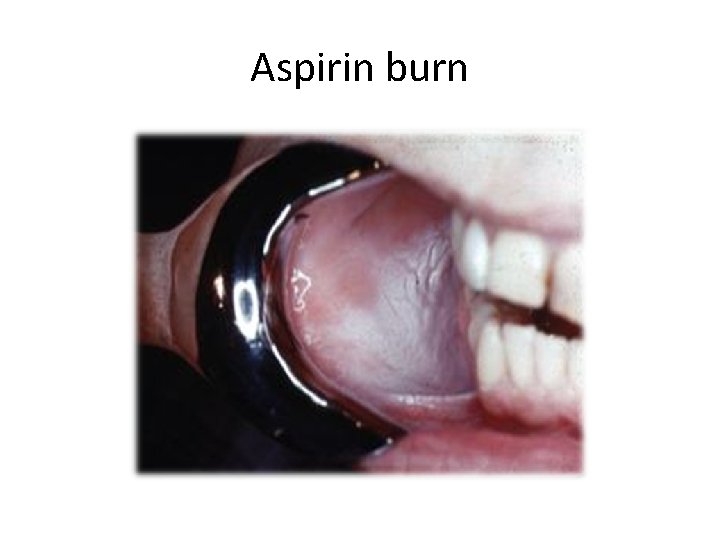 Aspirin burn 