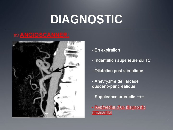 DIAGNOSTIC ANGIOSCANNER: - En expiration - Indentation supérieure du TC - Dilatation post sténotique