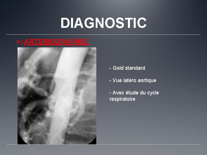 DIAGNOSTIC ARTERIOGRAPHIE: - Gold standard - Vue latéro aortique - Avec étude du cycle