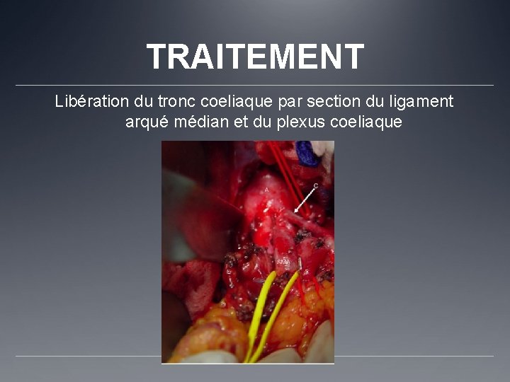 TRAITEMENT Libération du tronc coeliaque par section du ligament arqué médian et du plexus