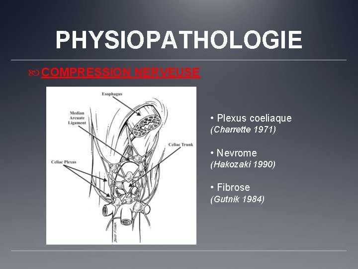 PHYSIOPATHOLOGIE COMPRESSION NERVEUSE • Plexus coeliaque (Charrette 1971) • Nevrome (Hakozaki 1990) • Fibrose
