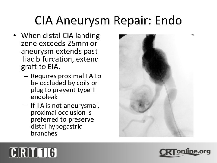 CIA Aneurysm Repair: Endo • When distal CIA landing zone exceeds 25 mm or