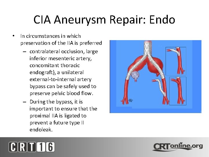 CIA Aneurysm Repair: Endo • In circumstances in which preservation of the IIA is