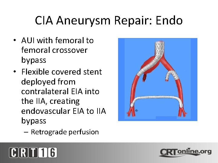 CIA Aneurysm Repair: Endo • AUI with femoral to femoral crossover bypass • Flexible