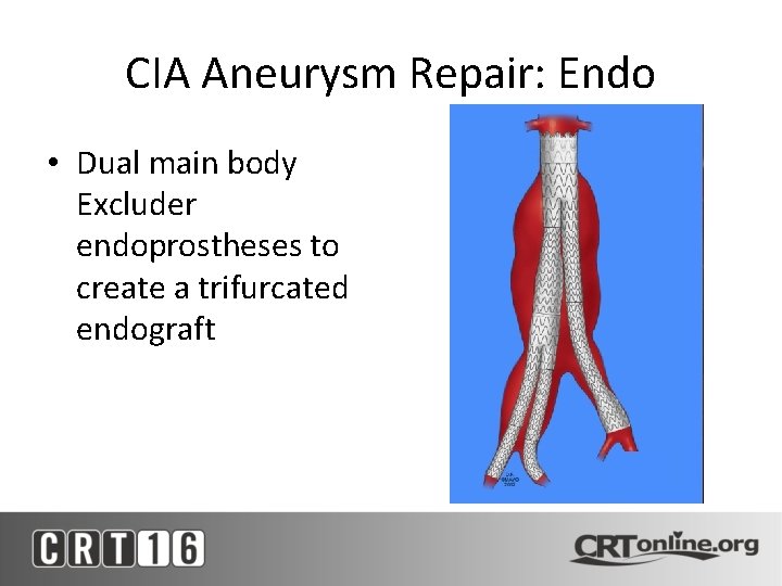 CIA Aneurysm Repair: Endo • Dual main body Excluder endoprostheses to create a trifurcated