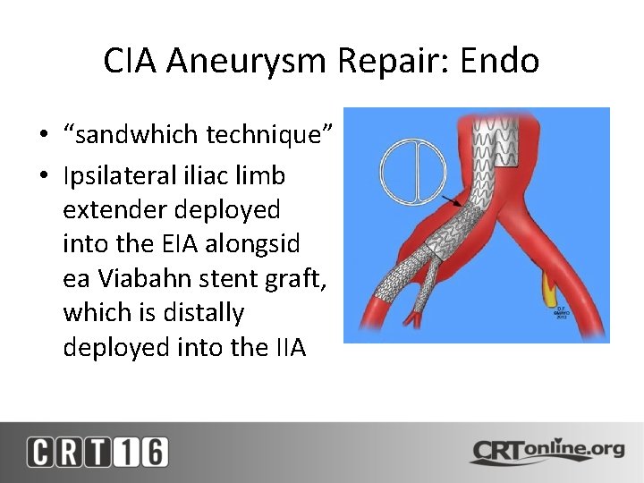 CIA Aneurysm Repair: Endo • “sandwhich technique” • Ipsilateral iliac limb extender deployed into