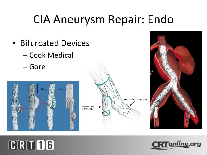 CIA Aneurysm Repair: Endo • Bifurcated Devices – Cook Medical – Gore 