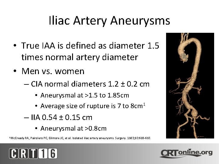 Iliac Artery Aneurysms • True IAA is defined as diameter 1. 5 times normal