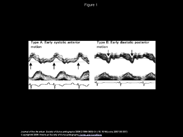 Figure 1 Journal of the American Society of Echocardiography 2008 21386 -393 DOI: (10.