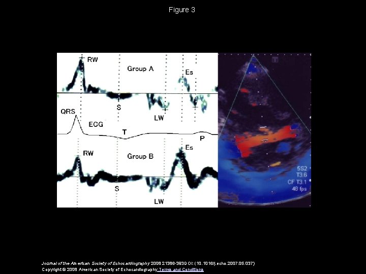 Figure 3 Journal of the American Society of Echocardiography 2008 21386 -393 DOI: (10.