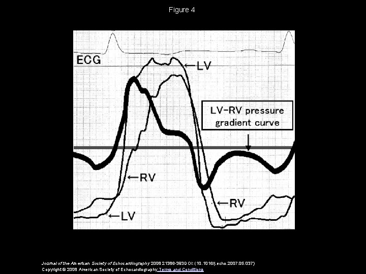 Figure 4 Journal of the American Society of Echocardiography 2008 21386 -393 DOI: (10.