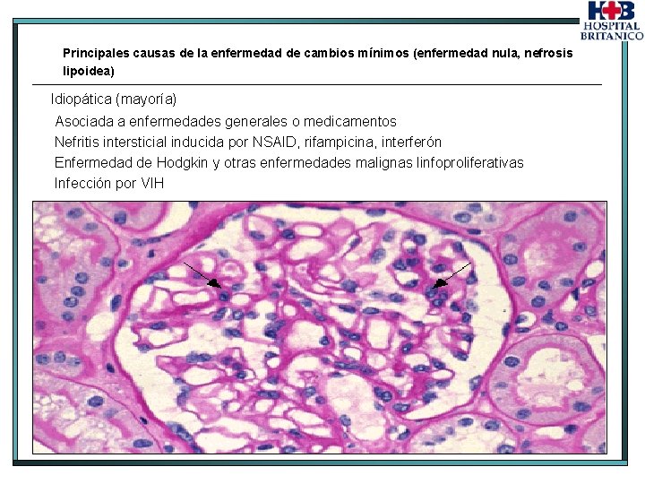 Principales causas de la enfermedad de cambios mínimos (enfermedad nula, nefrosis lipoidea) Idiopática (mayoría)