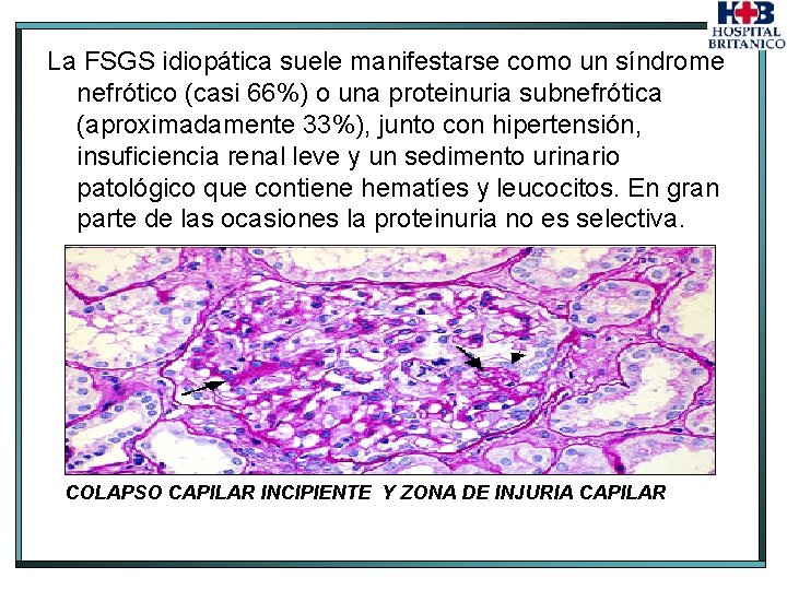 La FSGS idiopática suele manifestarse como un síndrome nefrótico (casi 66%) o una proteinuria