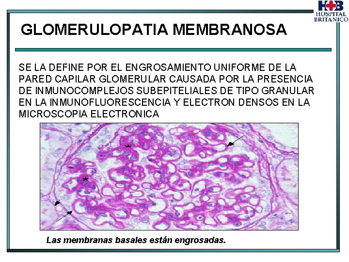 GLOMERULOPATIA MEMBRANOSA SE LA DEFINE POR EL ENGROSAMIENTO UNIFORME DE LA PARED CAPILAR GLOMERULAR